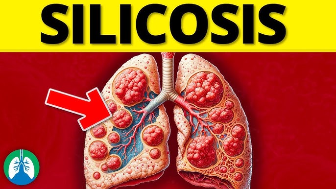 What is Silicosis?