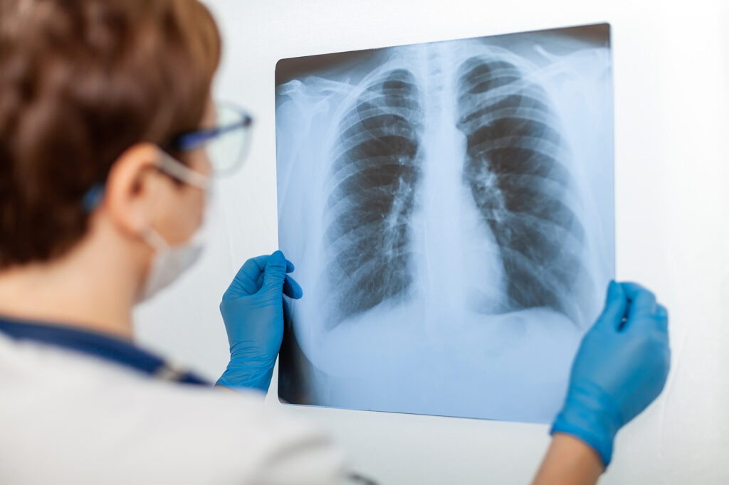 How Silicosis is Treated